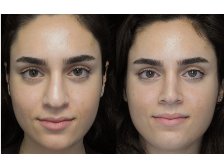 Illustration of a woman who underwent bulbous nasal tip rhinoplasty