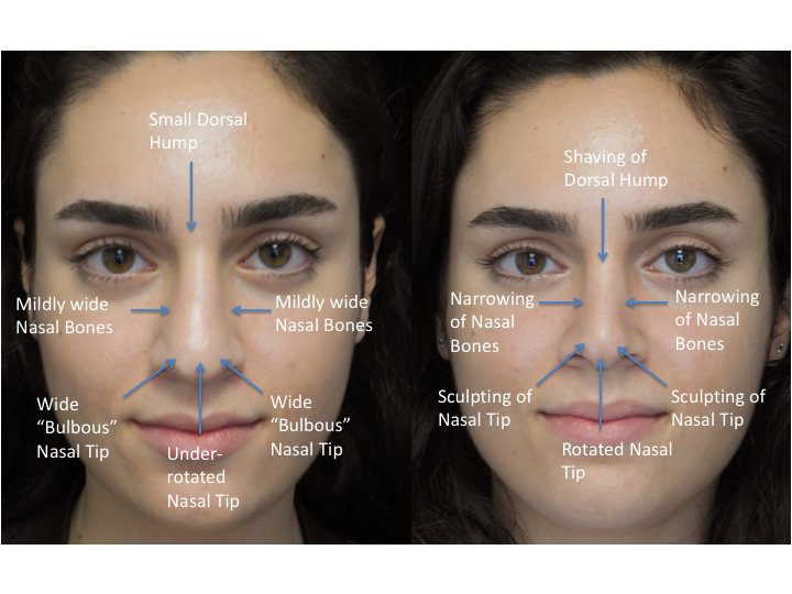 Illustration of a woman who underwent bulbous nasal tip rhinoplasty