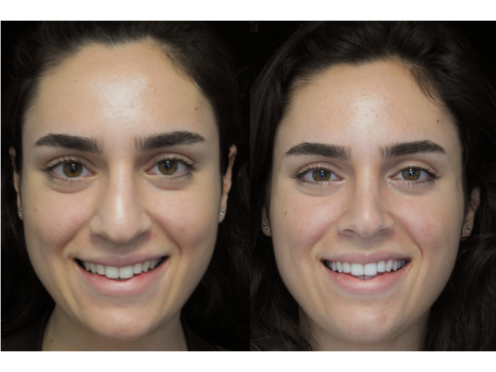 Illustration of a woman who underwent bulbous nasal tip rhinoplasty