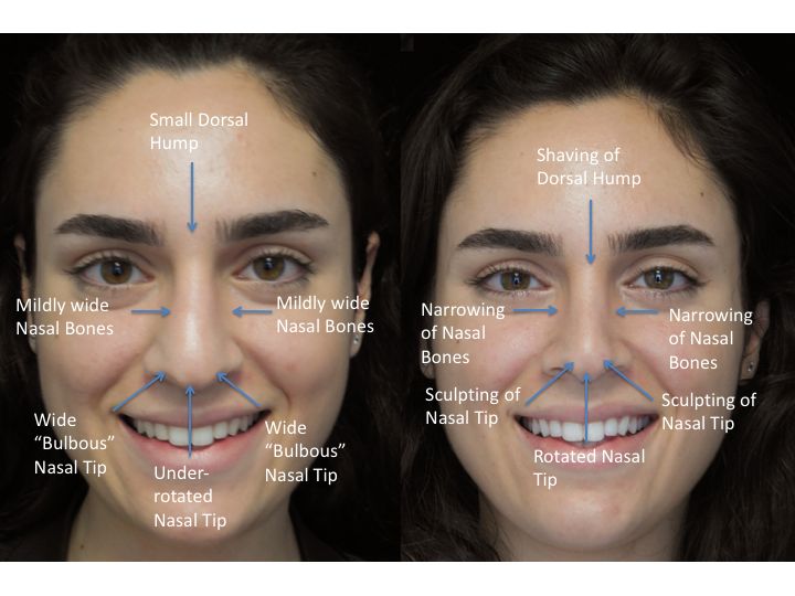 Illustration of a woman who underwent bulbous nasal tip rhinoplasty