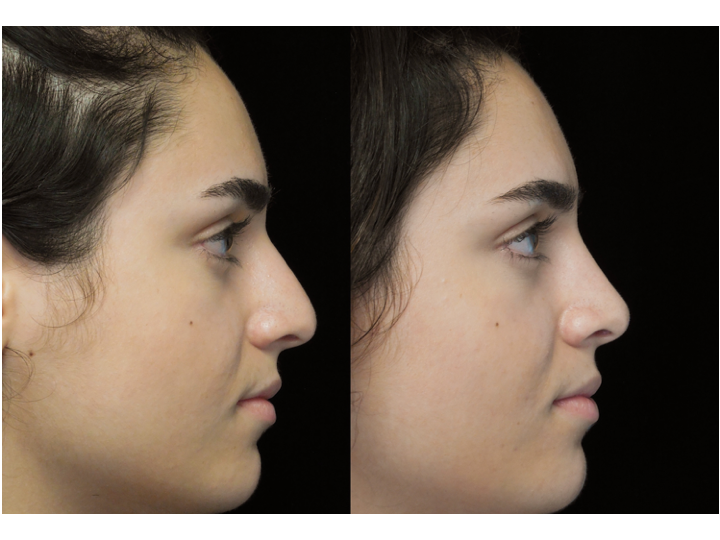 Illustration of a woman who underwent bulbous nasal tip rhinoplasty