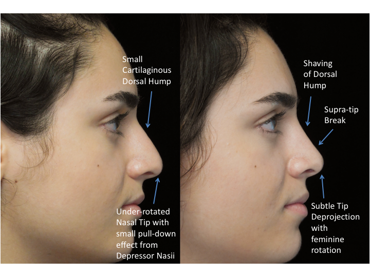 Illustration of a woman who underwent bulbous nasal tip rhinoplasty
