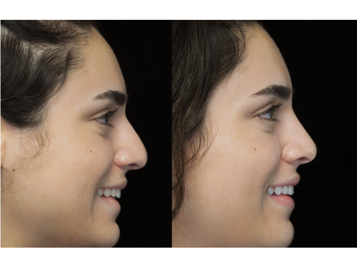 Illustration of a woman who underwent bulbous nasal tip rhinoplasty
