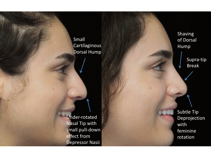 Illustration of a woman who underwent bulbous nasal tip rhinoplasty