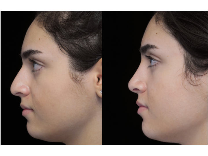 Illustration of a woman who underwent bulbous nasal tip rhinoplasty