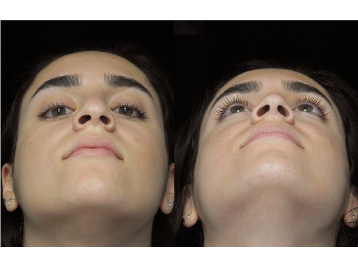 Illustration of a woman who underwent bulbous nasal tip rhinoplasty