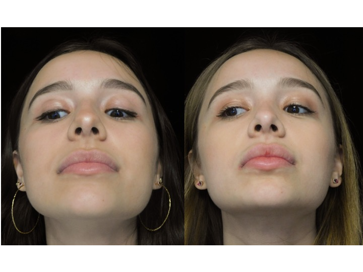 Illustration of a woman who underwent bulbous nasal tip rhinoplasty