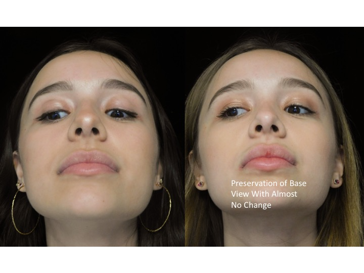 Illustration of a woman who underwent bulbous nasal tip rhinoplasty
