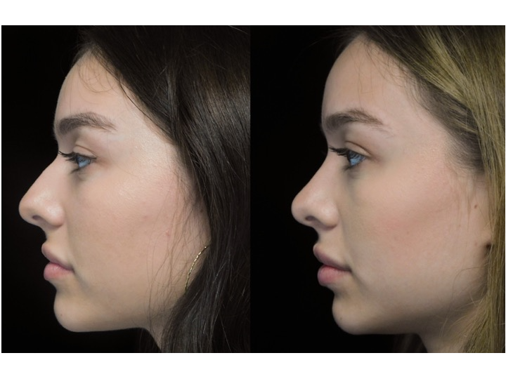 A woman who underwent rhinoplasty before and after illustration