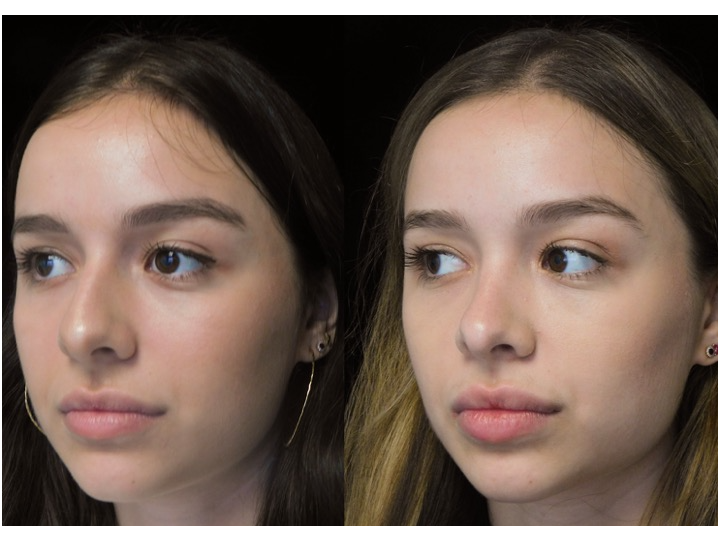 A woman who underwent rhinoplasty before and after illustration