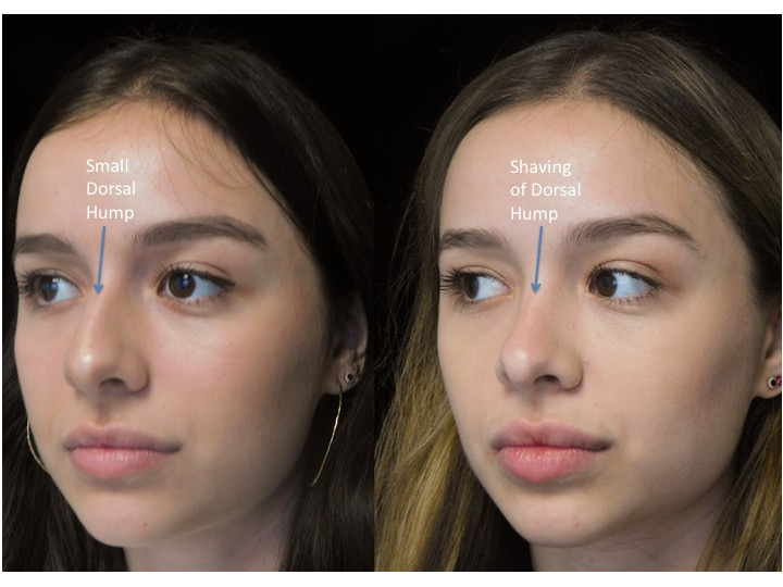 A woman who underwent rhinoplasty before and after illustration