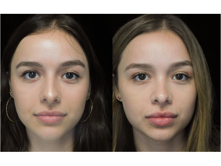 A woman who underwent rhinoplasty before and after illustration