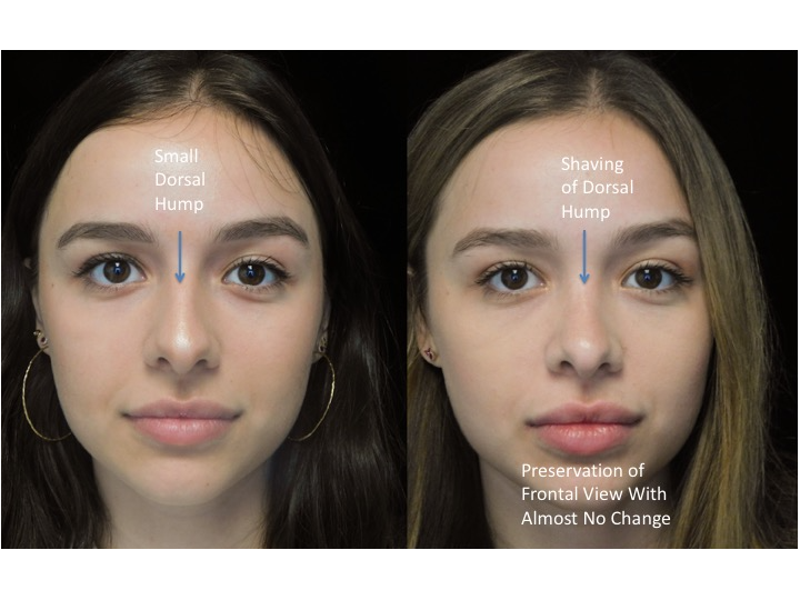A woman who underwent rhinoplasty before and after illustration