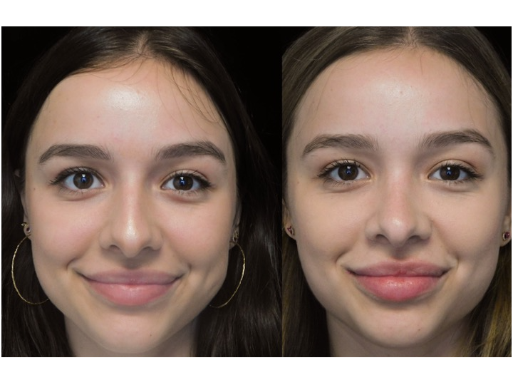 A woman who underwent rhinoplasty before and after illustration