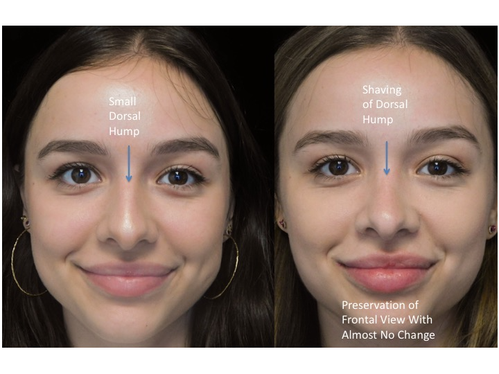 A woman who underwent rhinoplasty before and after illustration