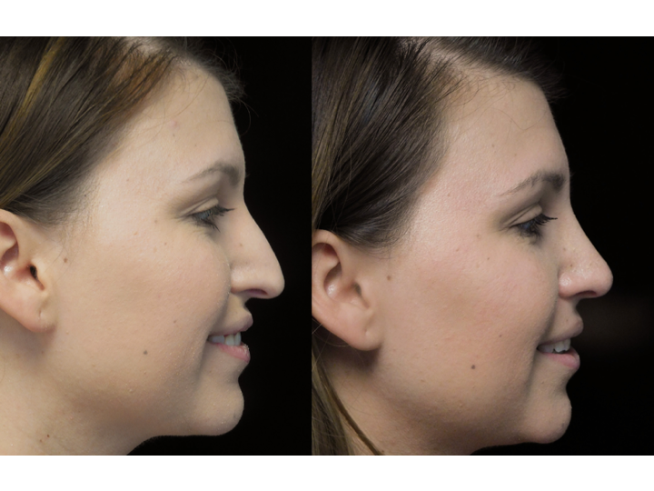 Illustration of a woman with bulbous tip who underwent bulbous tip reduction