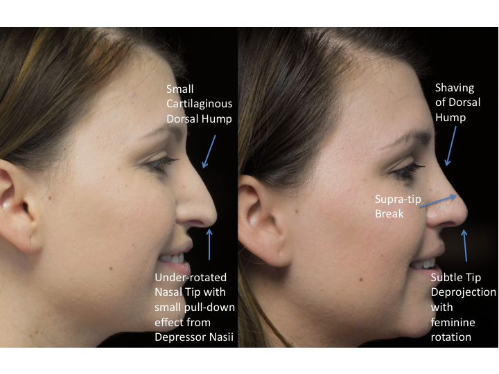 Illustration of a woman with bulbous tip who underwent bulbous tip reduction