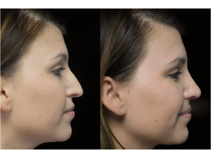 Illustration of a woman with bulbous tip who underwent bulbous tip reduction
