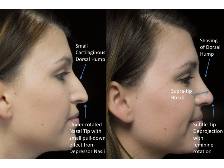 Illustration of a woman with bulbous tip who underwent bulbous tip reduction