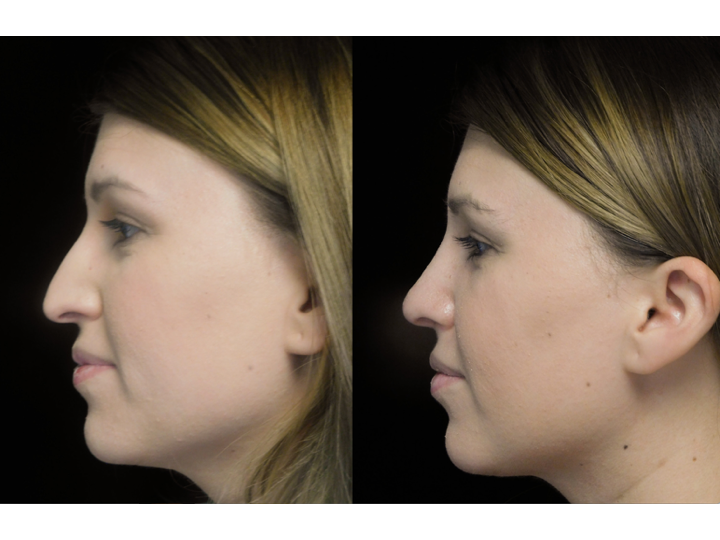 Illustration of a woman with bulbous tip who underwent bulbous tip reduction