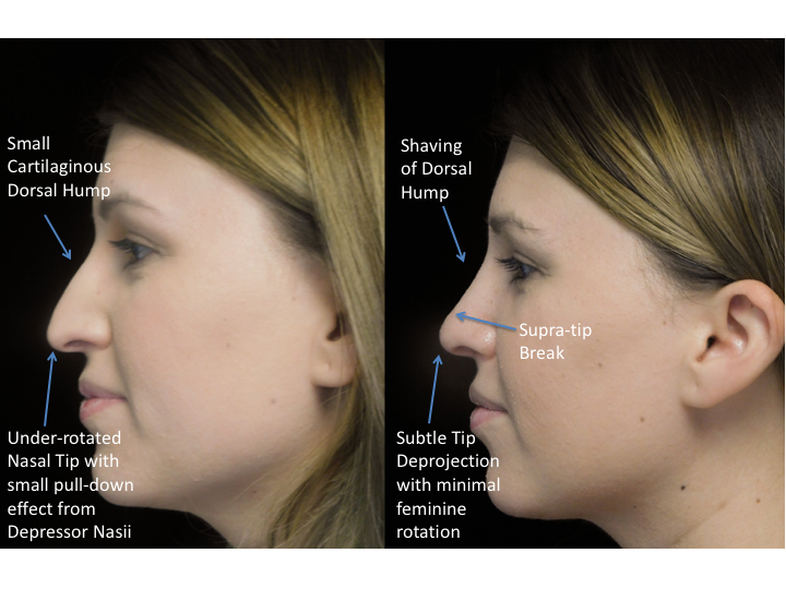 Illustration of a woman with bulbous tip who underwent bulbous tip reduction