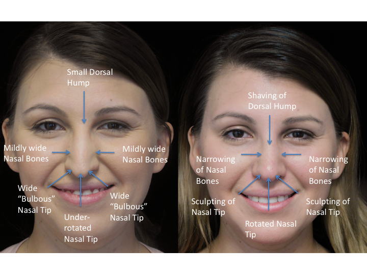 Illustration of a woman with bulbous tip who underwent bulbous tip reduction