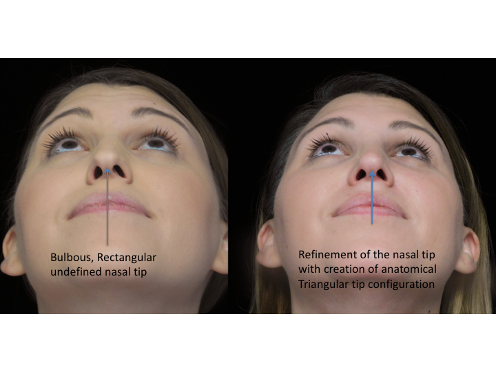 Illustration of a woman with bulbous tip who underwent bulbous tip reduction