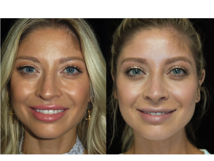 Illustration of a female patient with droopy nose tip who underwent a closed rhinoplasty tip refinement