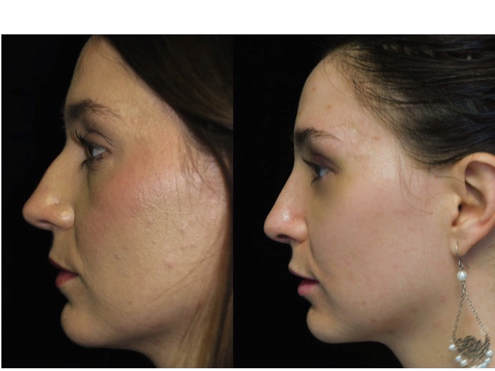 Nose job before and after of a female with small dorsal hump