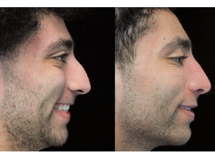 Before and after photo of a man who underwent bulbous nasal tip rhinoplasty