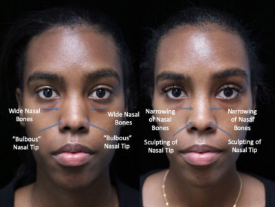 Does closed rhinoplasty heal faster? 