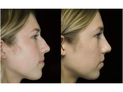 Subtle rhinoplasty
