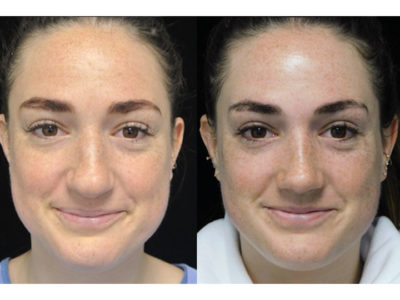 natural rhinoplasty