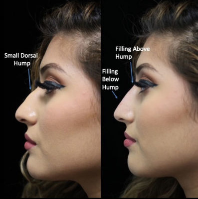 nose filler