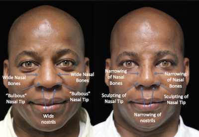 nostril narrowing