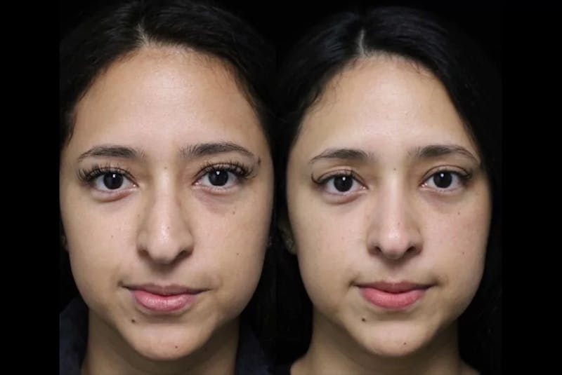 Bulb of nose sales