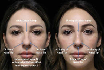 piezo rhinoplasty