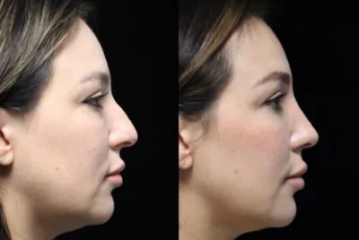 accutane