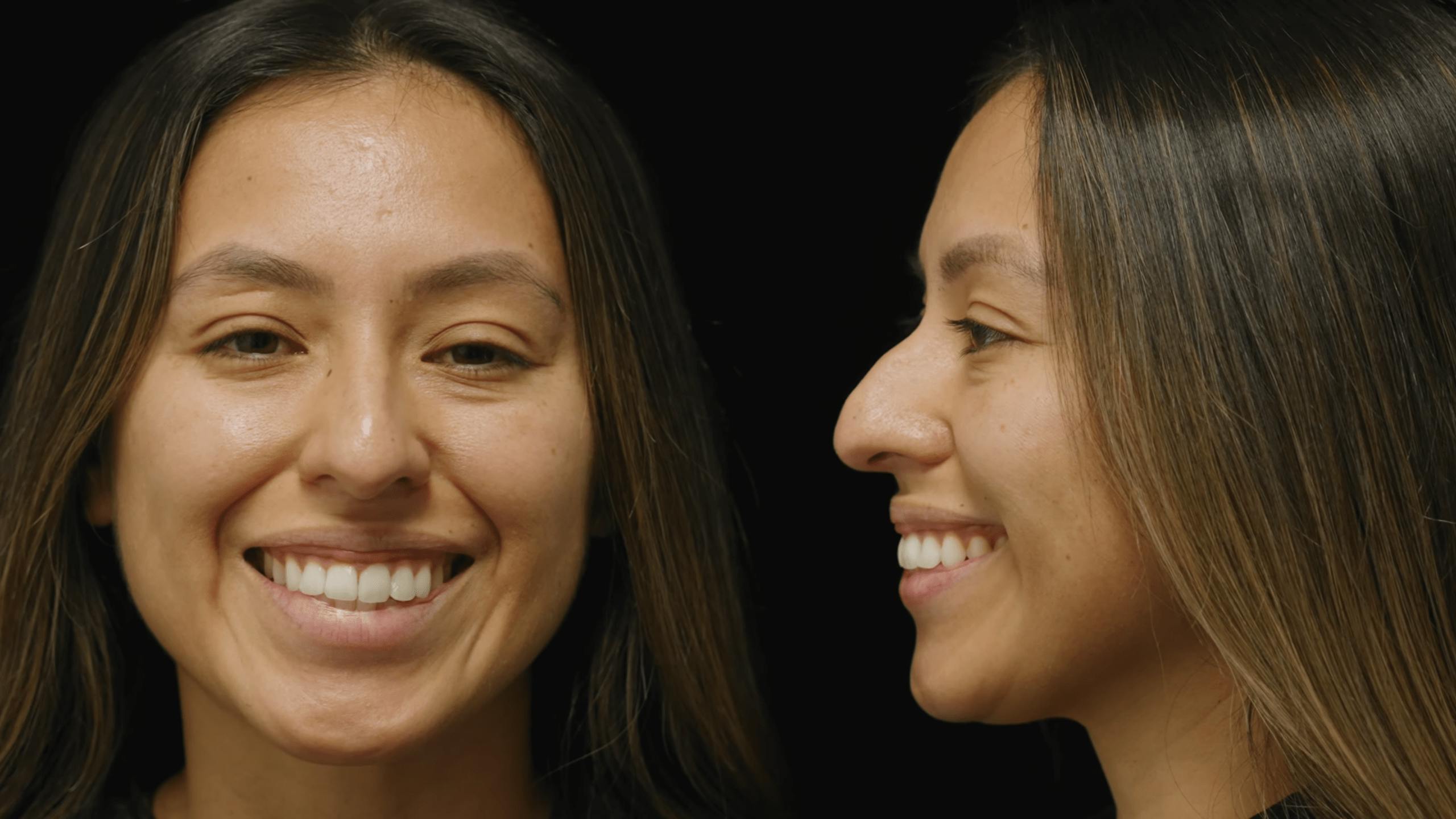 Beverly Hills Rhinoplasty