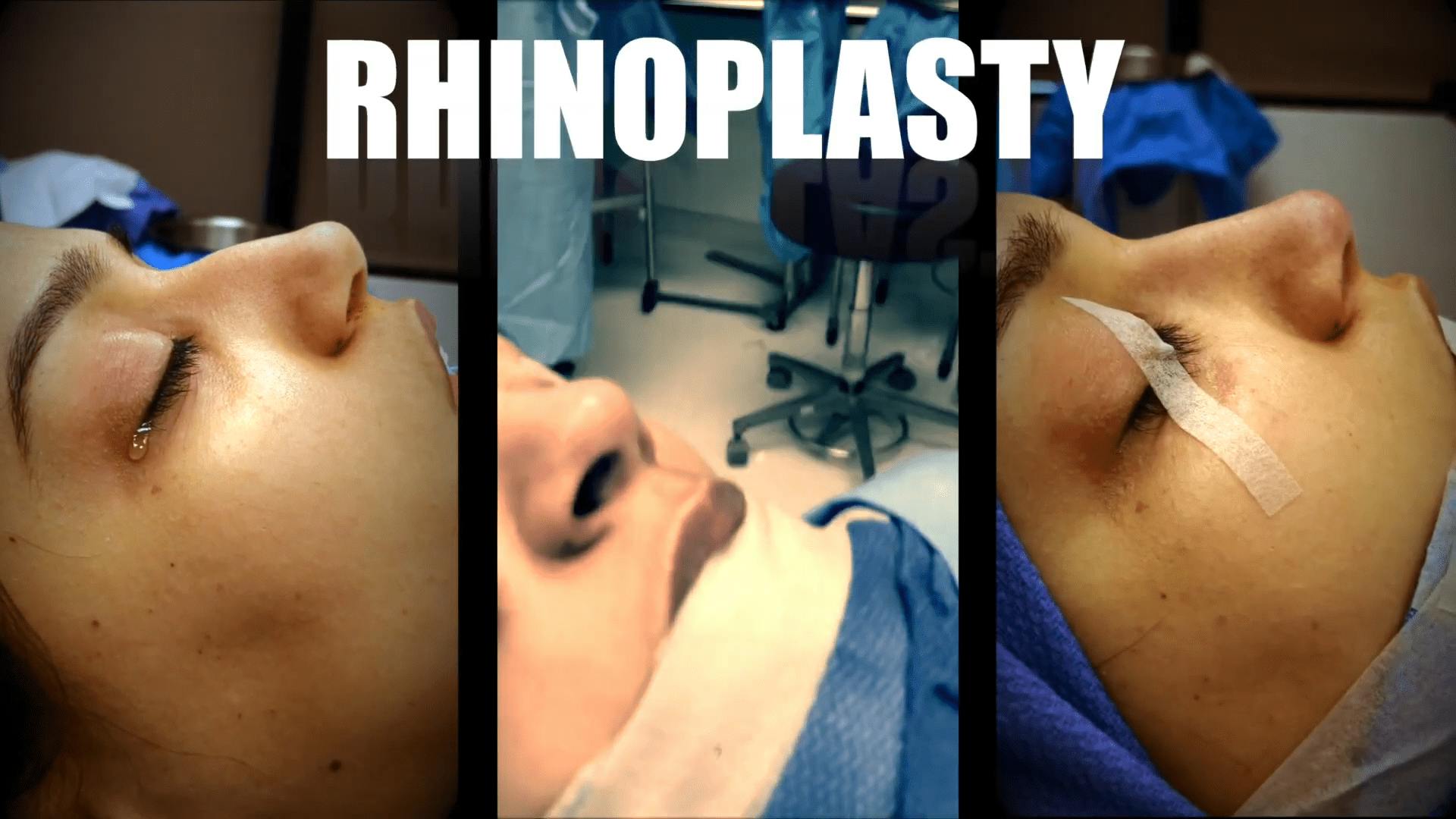 Beverly Hills Rhinoplasty