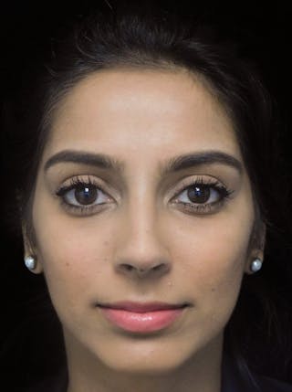 Beverly Hills Front View Rhinoplasty After in Beverly Hills by Dr. Deepak Raj Dugar | Patient 165430 Dr. Deepak Raj Dugar