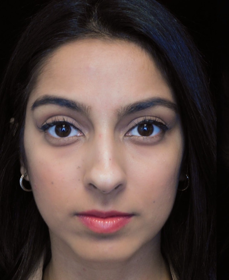 Beverly Hills Front View Rhinoplasty Before in Beverly Hills by Dr. Deepak Raj Dugar | Patient 165430 Dr. Deepak Raj Dugar