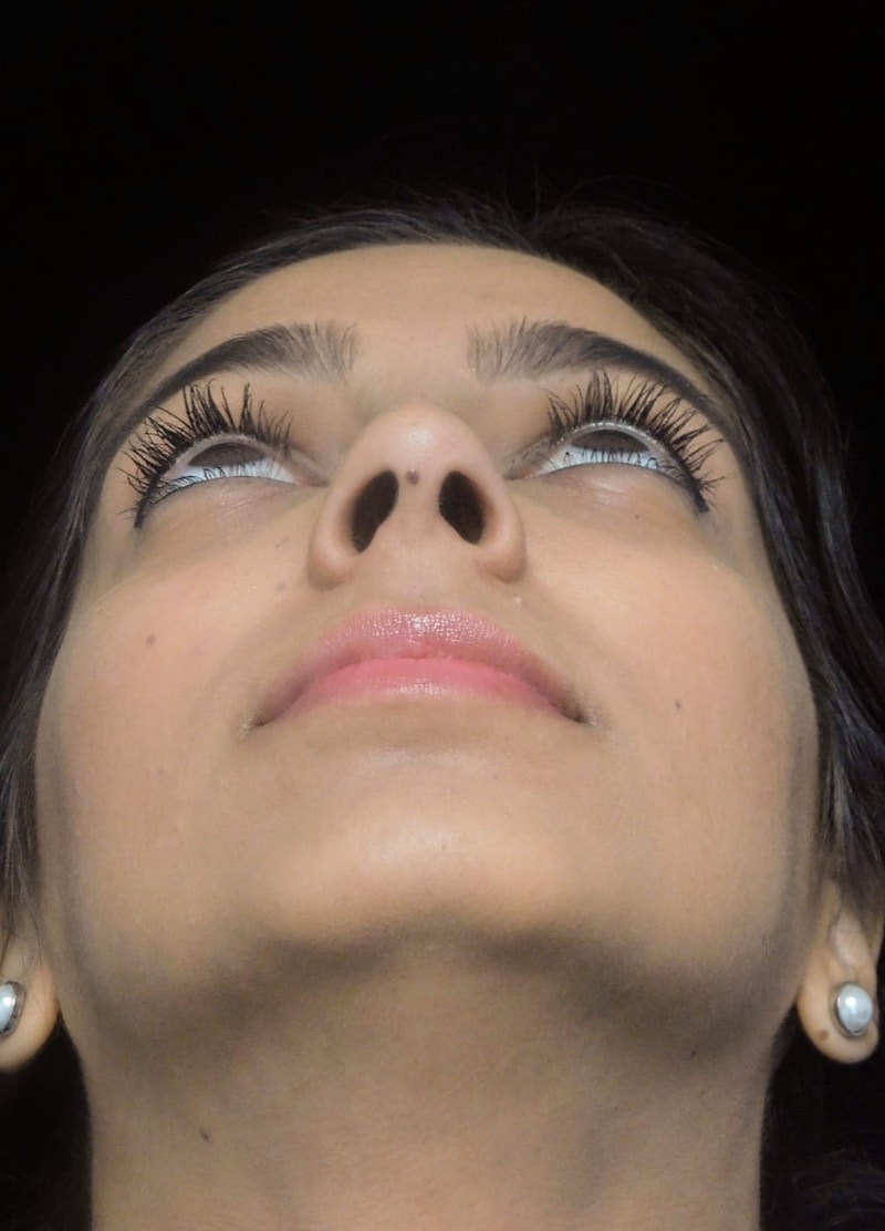 Beverly Hills Under View Rhinoplasty After in Beverly Hills by Dr. Deepak Raj Dugar | Patient 165430 Dr. Deepak Raj Dugar