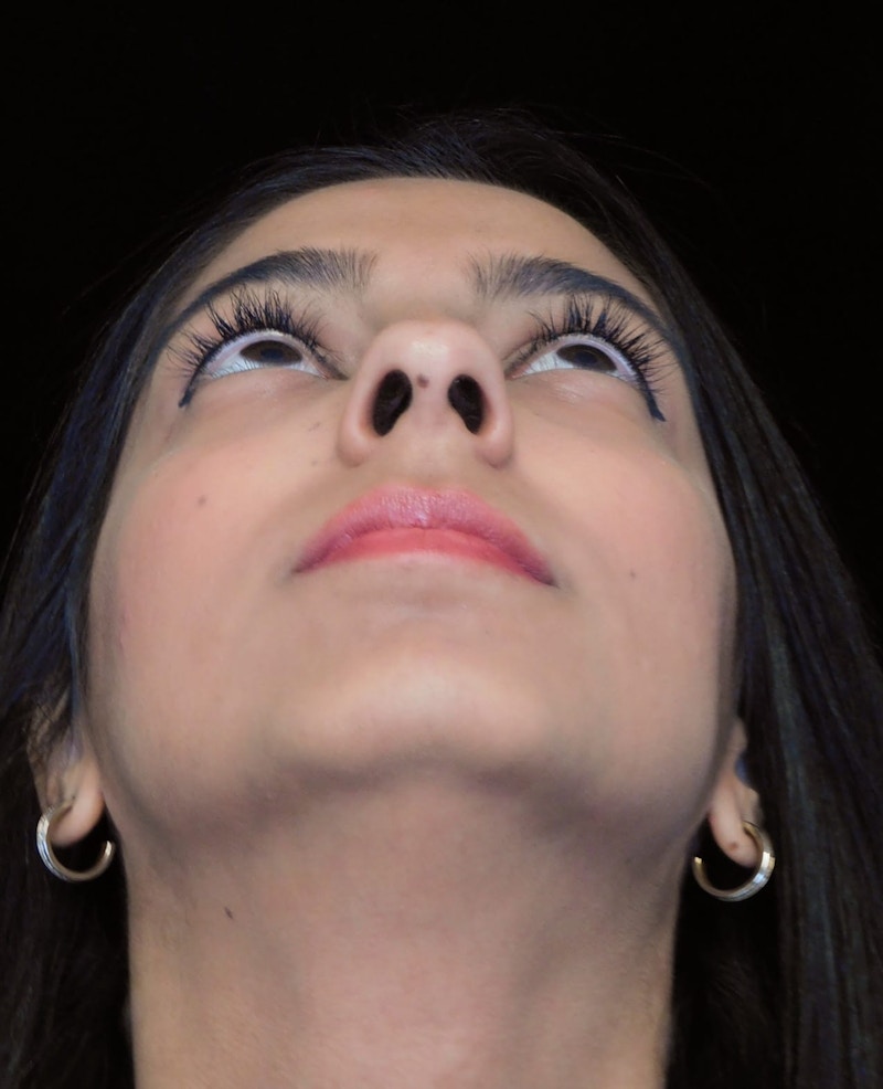Beverly Hills Under View Rhinoplasty Before in Beverly Hills by Dr. Deepak Raj Dugar | Patient 165430 Dr. Deepak Raj Dugar