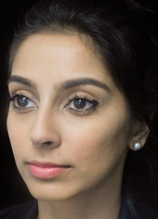 Beverly Hills Oblique View Rhinoplasty After in Beverly Hills by Dr. Deepak Raj Dugar | Patient 165430 Dr. Deepak Raj Dugar