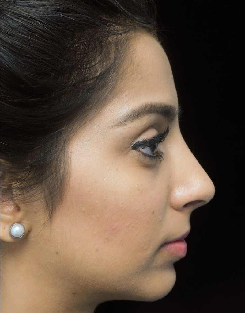 Beverly Hills Side View Rhinoplasty After in Beverly Hills by Dr. Deepak Raj Dugar | Patient 165430 Dr. Deepak Raj Dugar