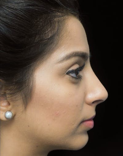 Beverly Hills Side View Rhinoplasty After in Beverly Hills by Dr. Deepak Raj Dugar | Patient 165430 Dr. Deepak Raj Dugar