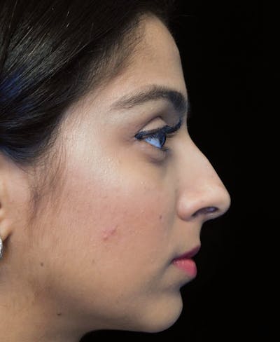 Beverly Hills Side View Rhinoplasty Before in Beverly Hills by Dr. Deepak Raj Dugar | Patient 165430 Dr. Deepak Raj Dugar