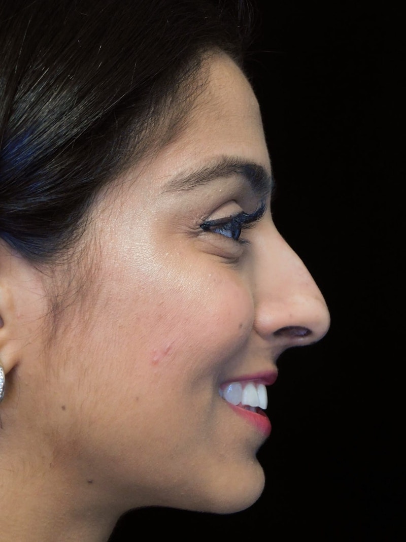 Beverly Hills Side Smile View Rhinoplasty Before in Beverly Hills by Dr. Deepak Raj Dugar | Patient 165430 Dr. Deepak Raj Dugar