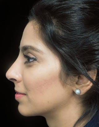 Beverly Hills Left Side View Rhinoplasty After in Beverly Hills by Dr. Deepak Raj Dugar | Patient 165430 Dr. Deepak Raj Dugar
